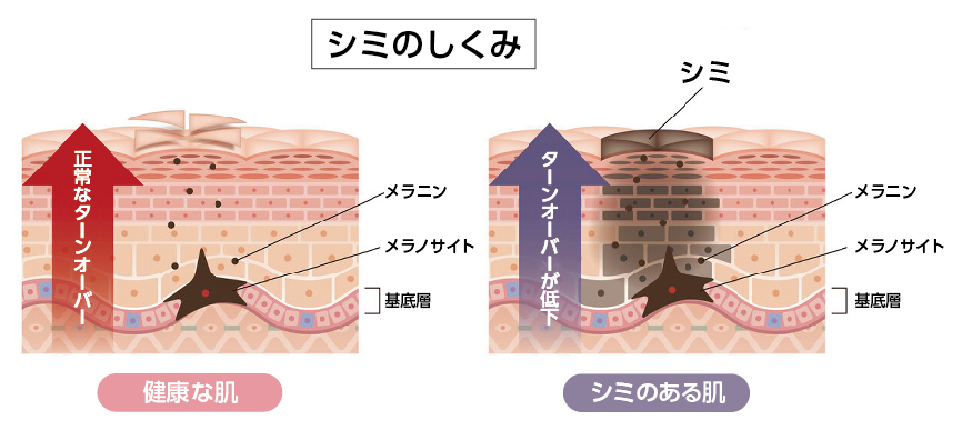 シミのしくみ